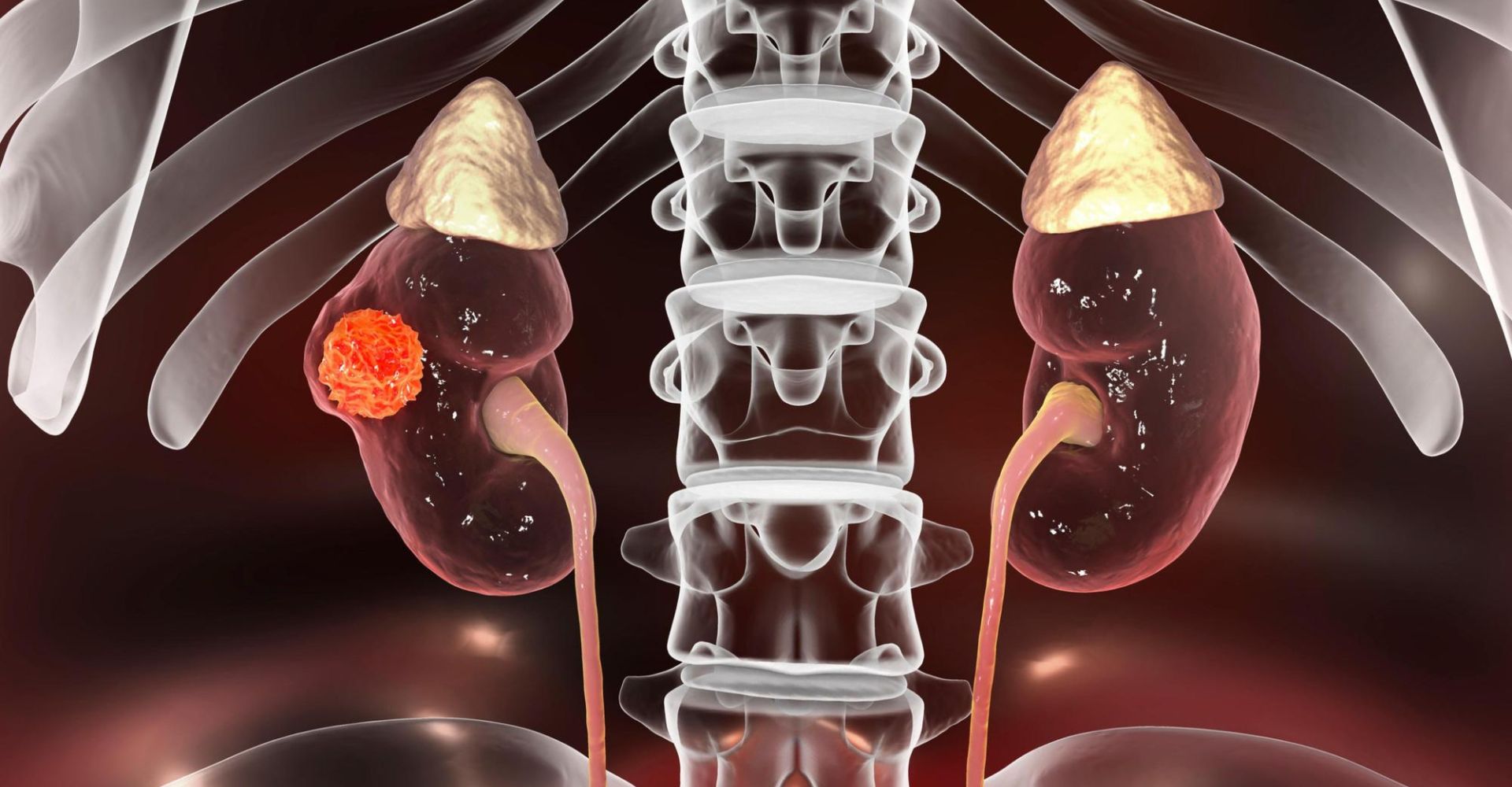 Is 3mm Kidney Stone Dangerous?