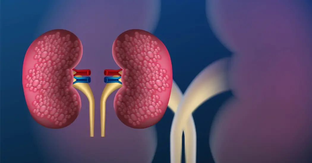 Types of Kidney Stones