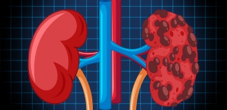 What Size of Kidney Stone Requires Surgery? A Complete Guide