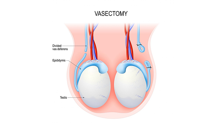 Best Vasectomy procedure at MITR Urology Associates and Hospital in Navi Mumbai, with centres at Panvel, Kharghar, Ulwe, and Vashi.