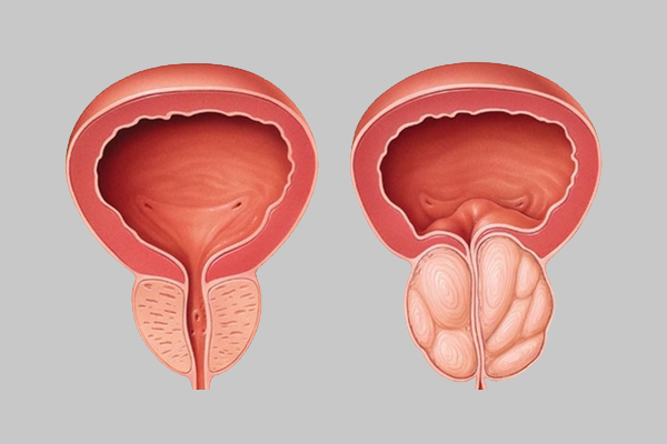 Best Benign Prostate Enlargement Treatment at MITR Urology Associates and Hospital in Navi Mumbai, with centres at Panvel, Kharghar, Ulwe, and Vashi.