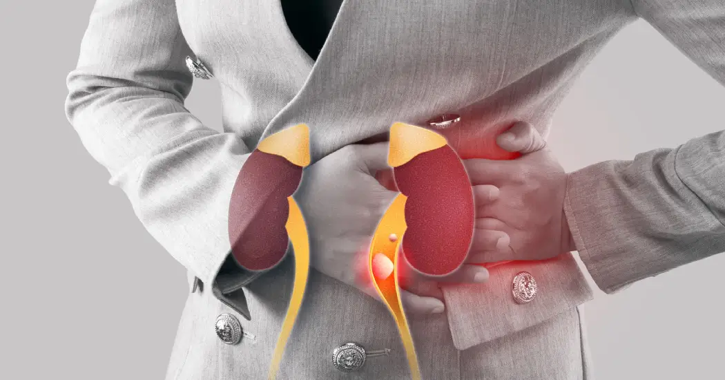 Types of Kidney Stones