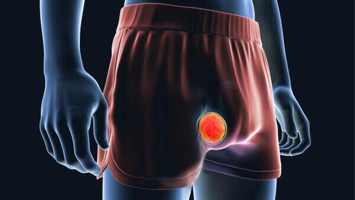 Best Treatment of Tescular Problems at MITR Urology Associates and Hospital in Navi Mumbai, with centres at Panvel, Kharghar, Ulwe, and Vashi.